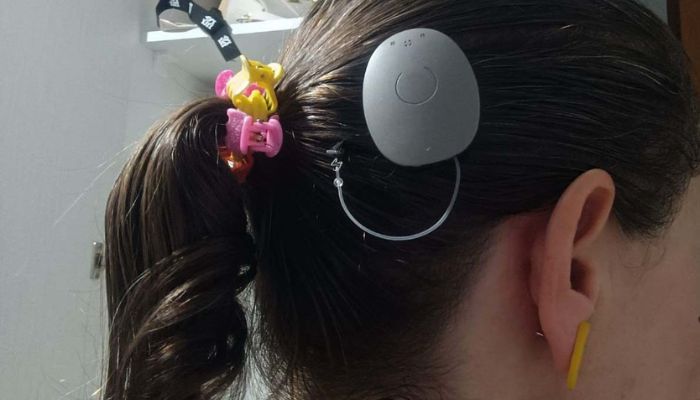  Paraná assume liderança nacional em implantes de correção auditiva pelo SUS 